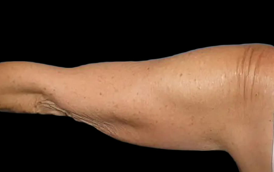 Case--20912 | Before Arm Lift