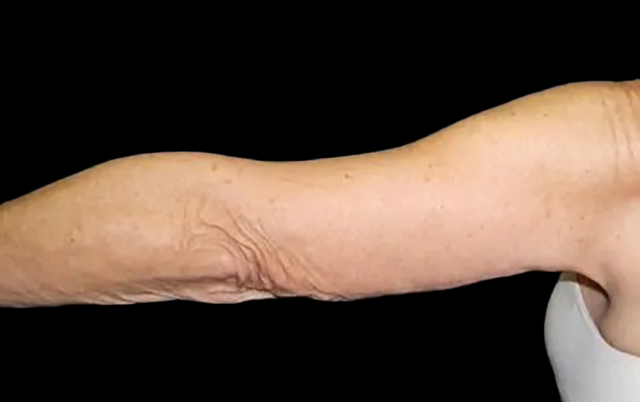 Case--20912 | After Arm Lift