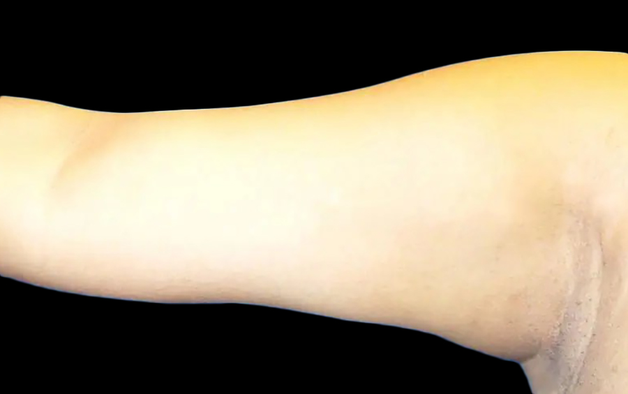 Case--20924 | Before Arm Lift