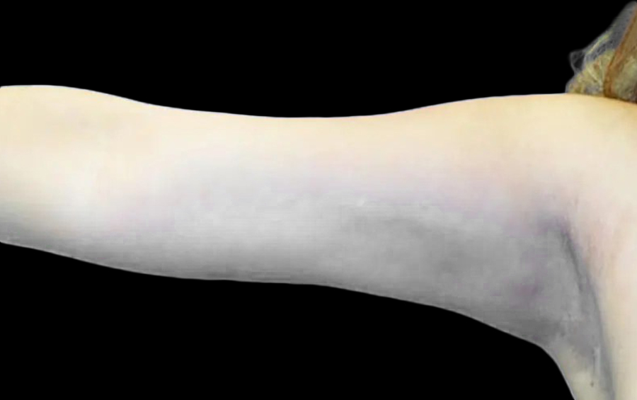 Case--20924 | After Arm Lift