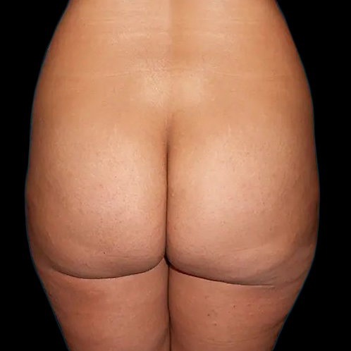 Before and after brazilian butt lift New York Case 1a