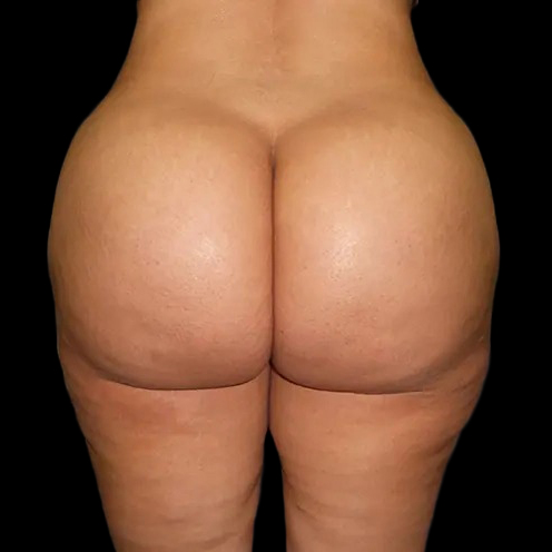 Before and after brazilian butt lift New York Case 1b