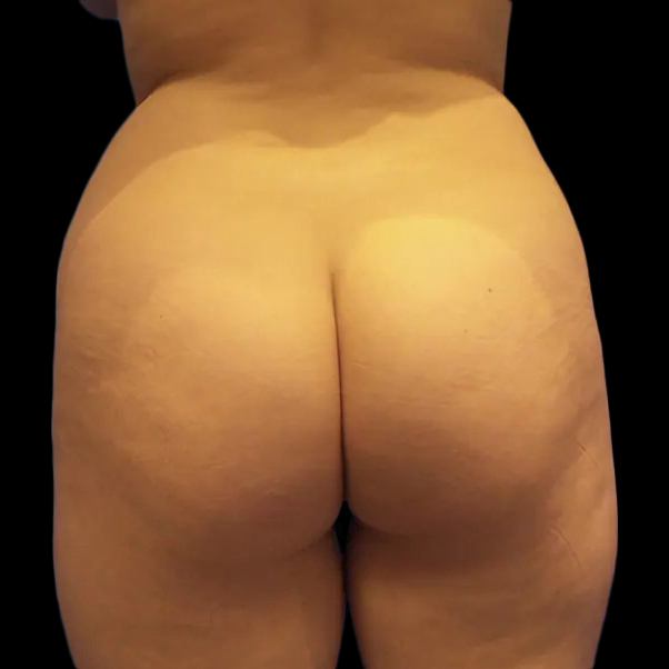 Case--20955 | Before Brazilian Butt Lift