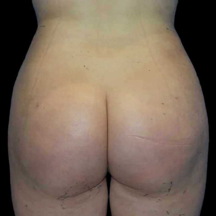 Case--20955 | After Brazilian Butt Lift