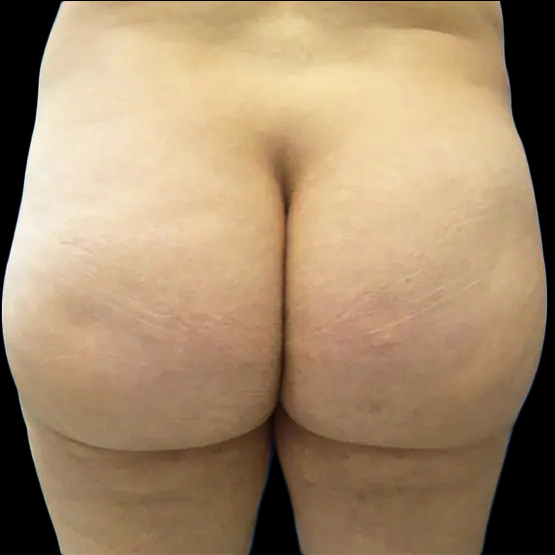 Case--20966 | Before Brazilian Butt Lift