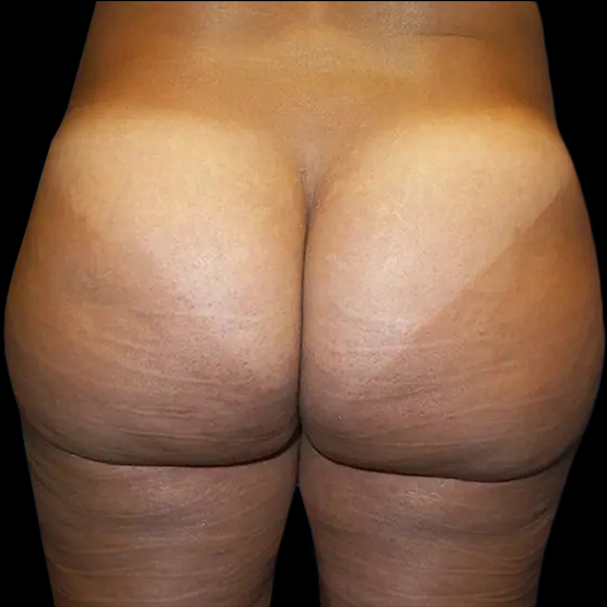 Case--20966 | After Brazilian Butt Lift