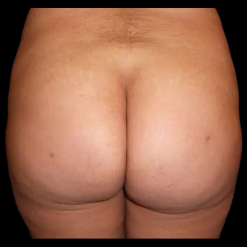 Case--20967 | After Brazilian Butt Lift