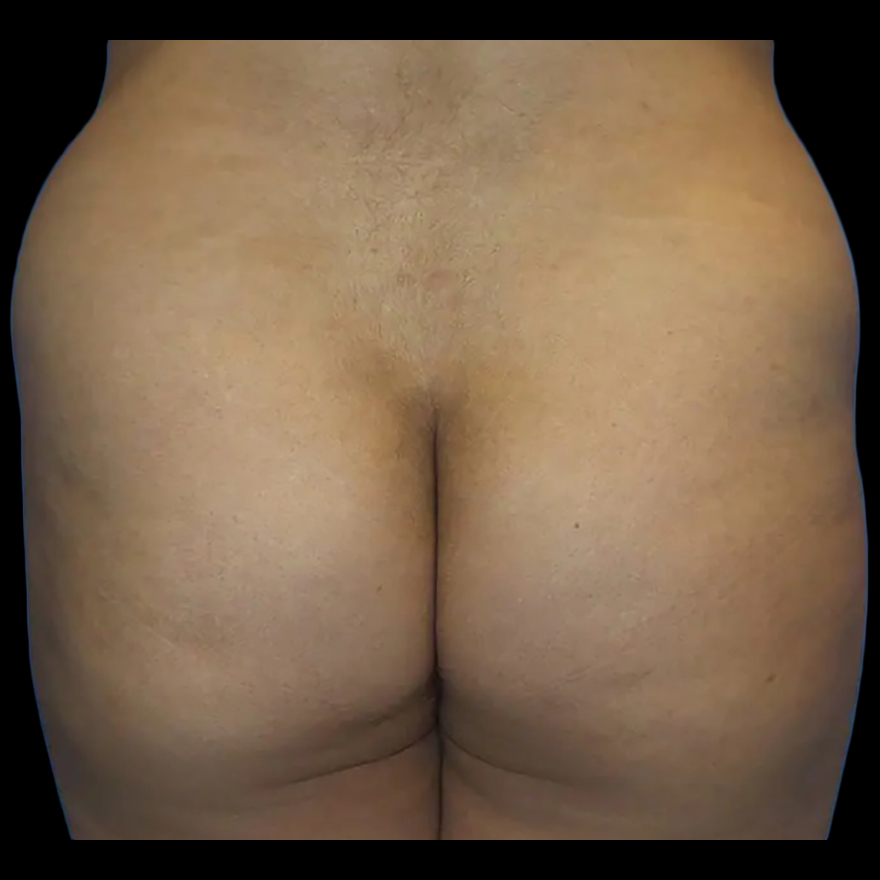Case--21022 | Before Brazilian Butt Lift
