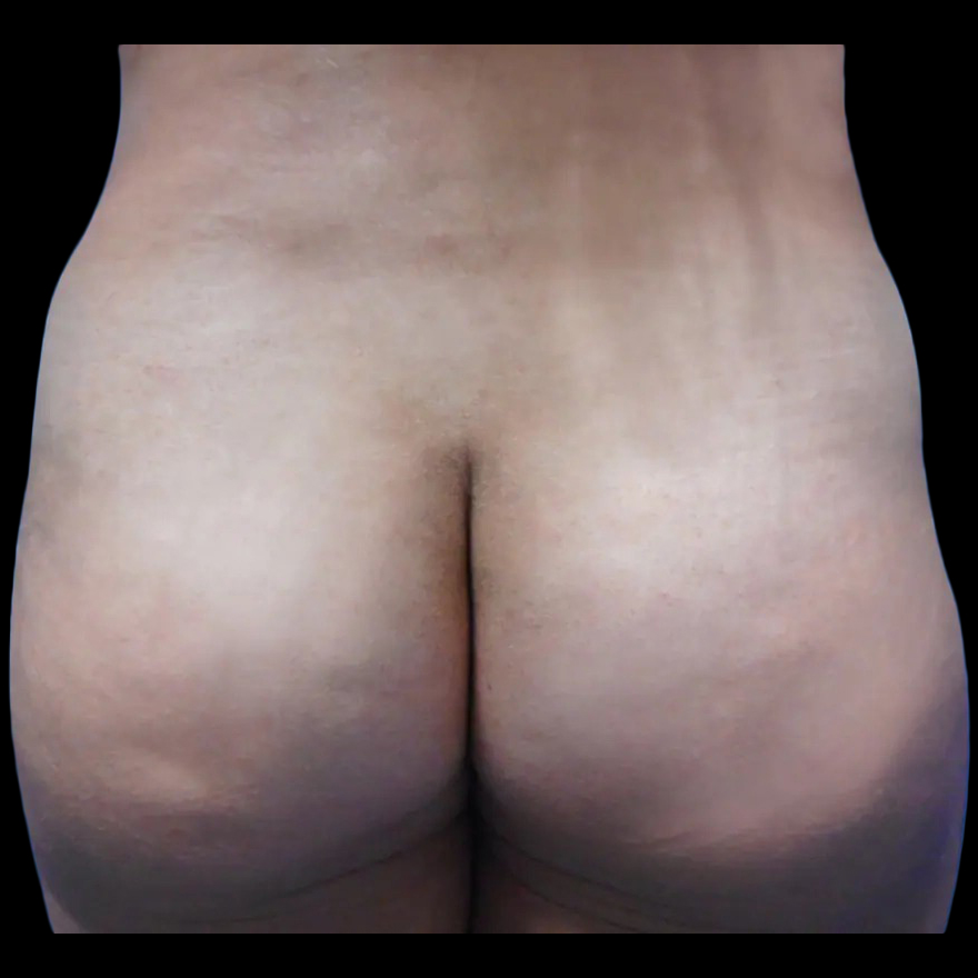 Case--21022 | After Brazilian Butt Lift