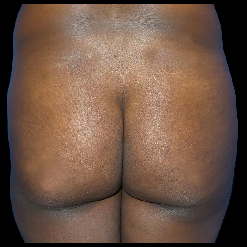 Before and after brazilian butt lift New York Case 7a