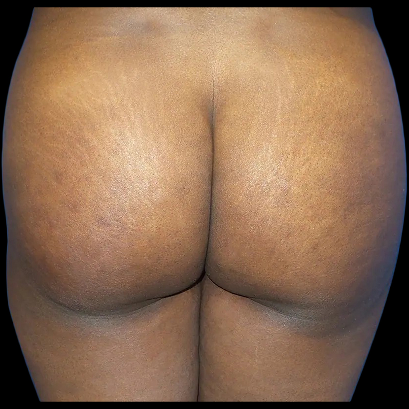 Before and after brazilian butt lift New York Case 7b