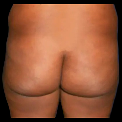 Case--21025 | Before Brazilian Butt Lift
