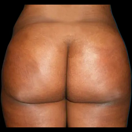 Case--21025 | After Brazilian Butt Lift