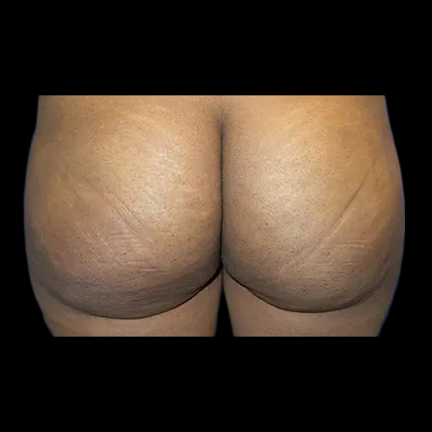 Case--21027 | Before Brazilian Butt Lift