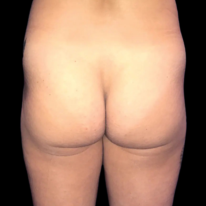Case--21032 | Before Brazilian Butt Lift