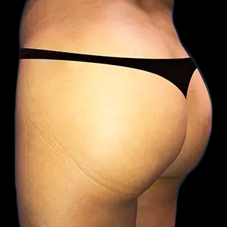 Before and after brazilian butt lift New York Case 12d