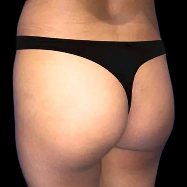 Before and after brazilian butt lift New York Case 12c