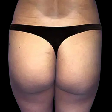 Before and after brazilian butt lift New York Case 12a