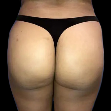 Before and after brazilian butt lift New York Case 12b