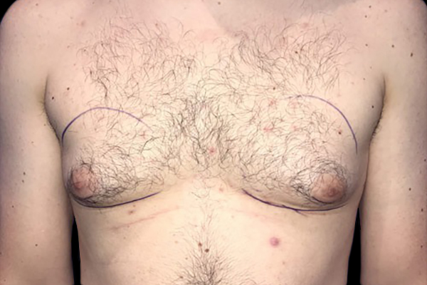 Case--21056 | Before Gynecomastia