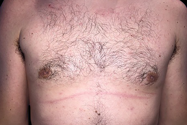 Case--21056 | After Gynecomastia
