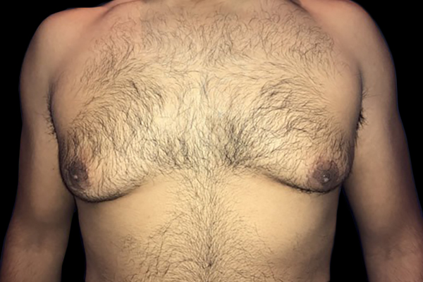 Case--21057 | Before Gynecomastia