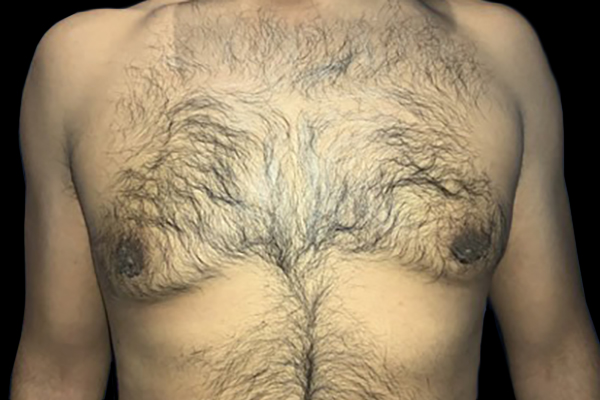Case--21057 | After Gynecomastia