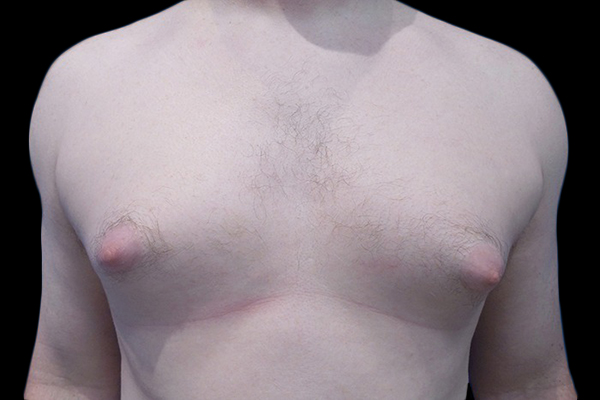 Case--21044 | Before Gynecomastia