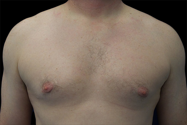 Case--21044 | After Gynecomastia