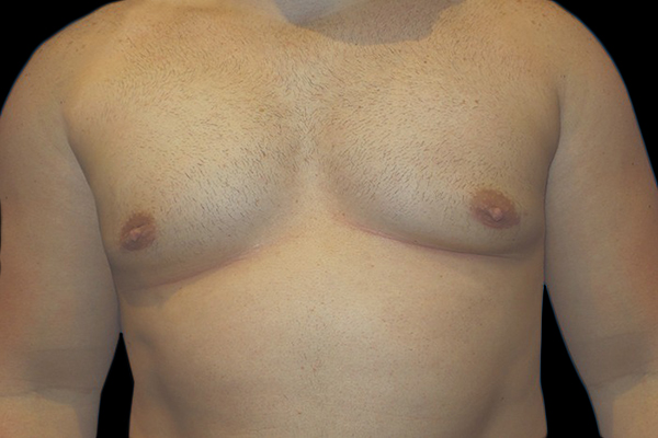 Case--21045 | After Gynecomastia