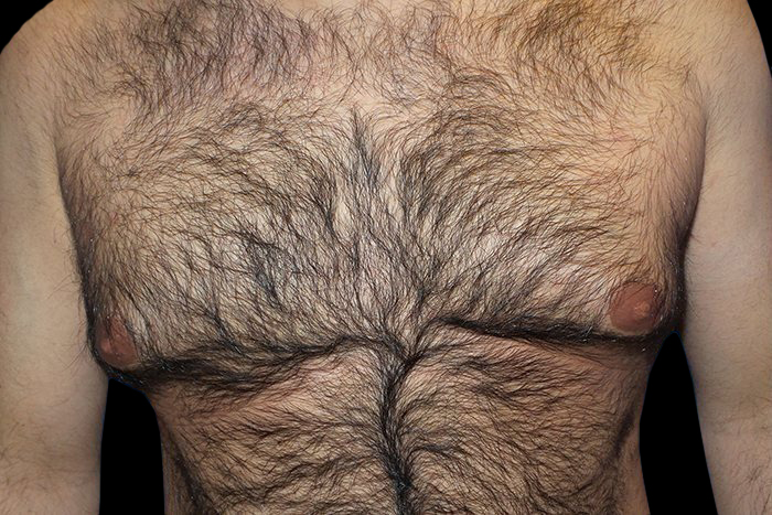 Case--21046 | Before Gynecomastia