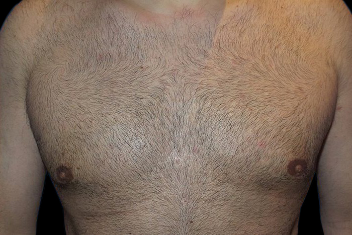 Case--21046 | After Gynecomastia