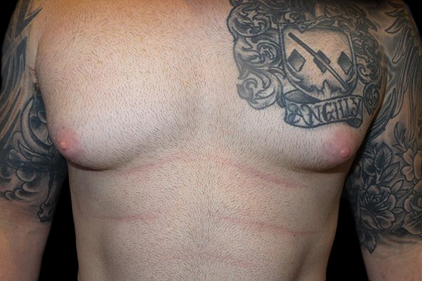 Case--21047 | Before Gynecomastia