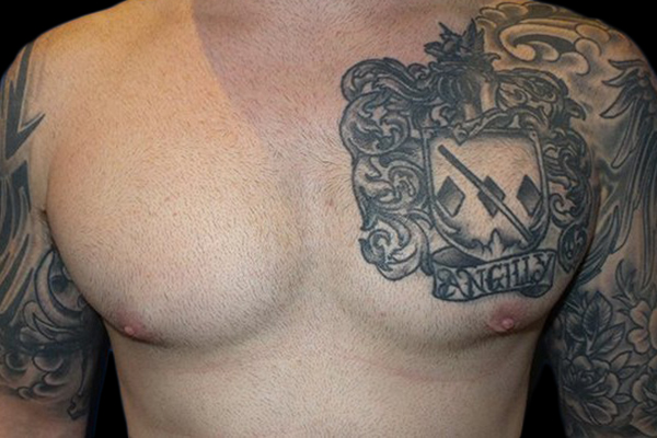 Case--21047 | After Gynecomastia