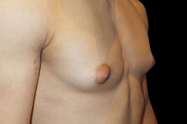 Case--21048 | Before Gynecomastia