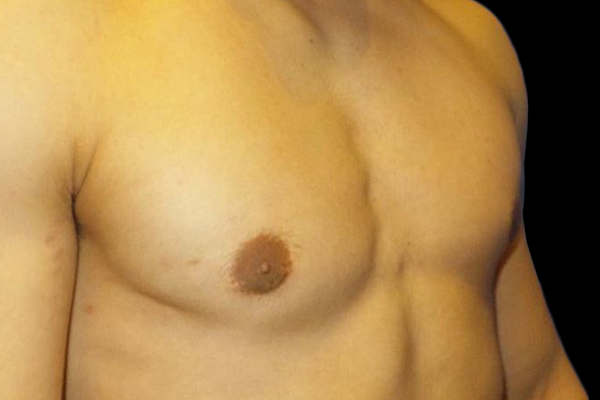 Case--21048 | After Gynecomastia