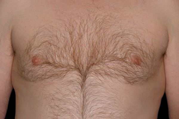 Case--21049 | After Gynecomastia