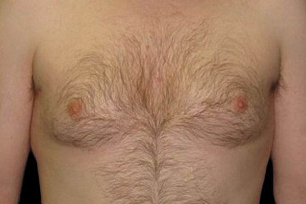 Case--21049 | Before Gynecomastia