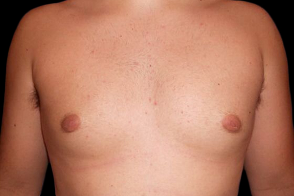 Case--21050 | After Gynecomastia