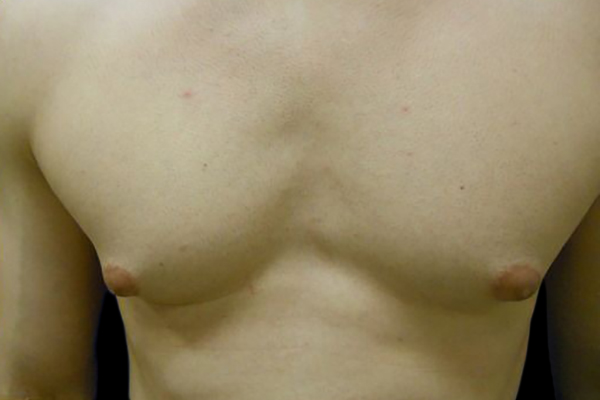 Case--21051 | Before Gynecomastia