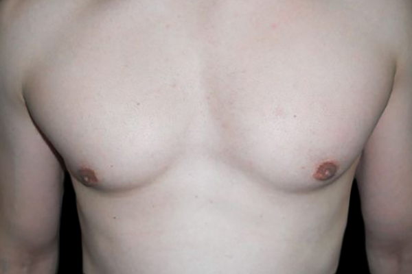 Case--21051 | After Gynecomastia