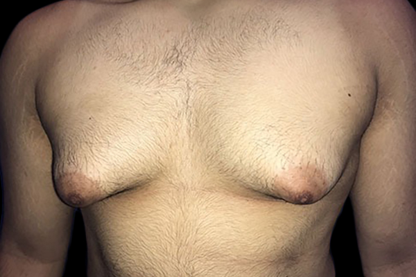 Case--21058 | Before Gynecomastia
