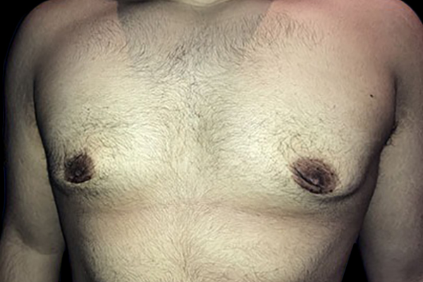 Case--21058 | After Gynecomastia