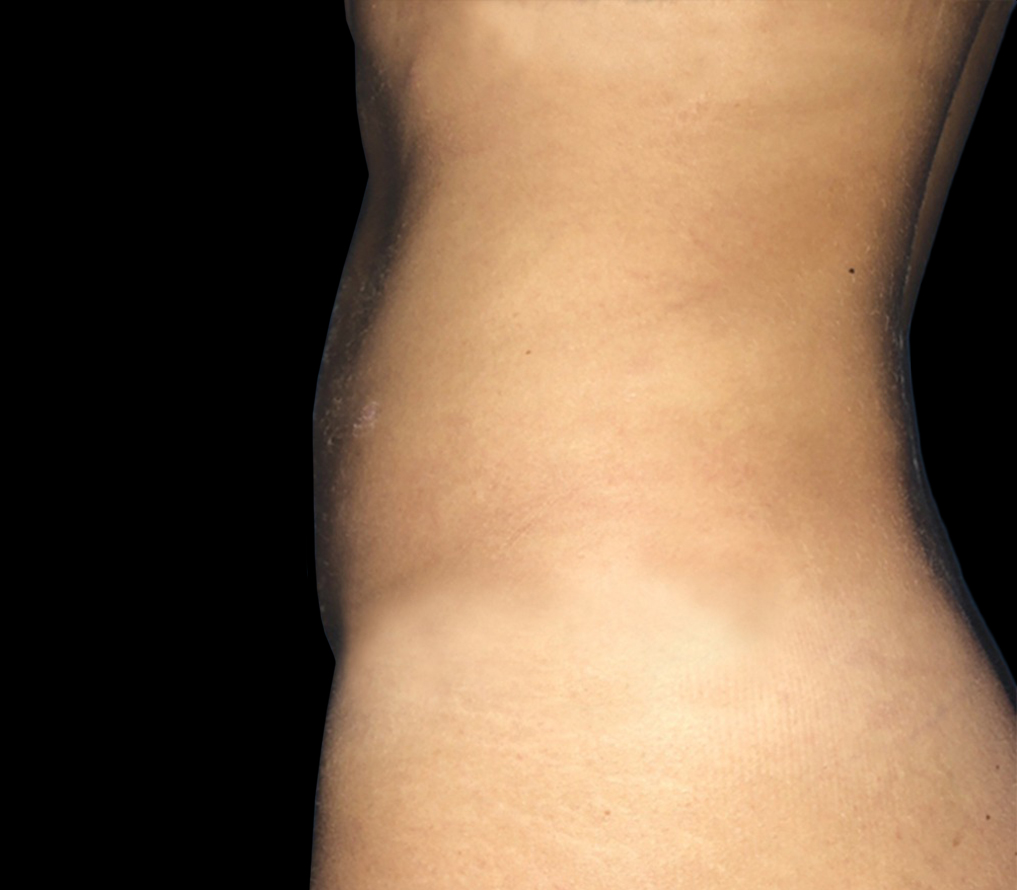 Case--21133 | After Liposuction