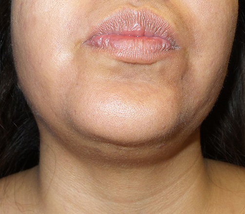 Face Liposuction Before and After 3a