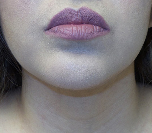 Face Liposuction Before and After 3b