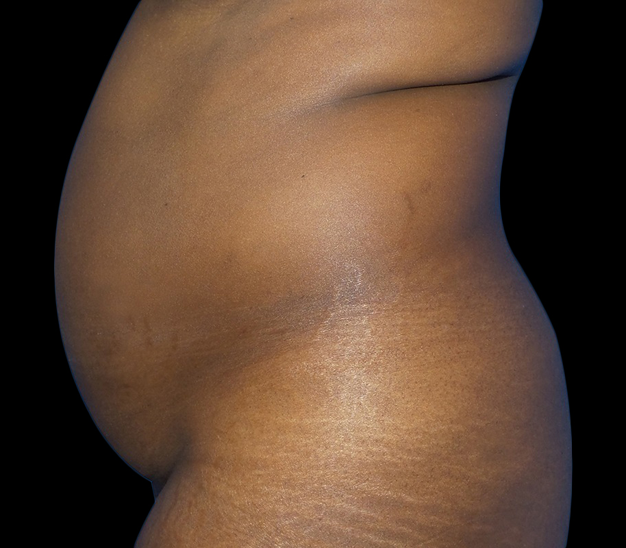 Case--21159 | Before Liposuction