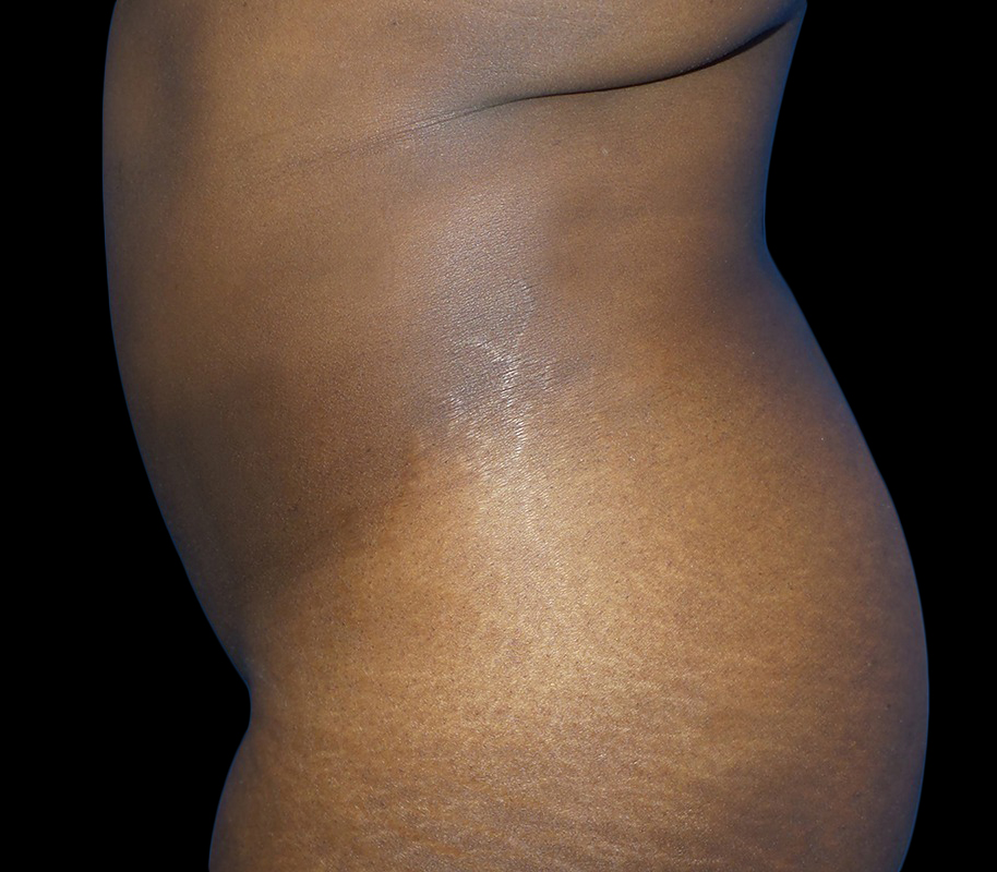 Case--21159 | After Liposuction