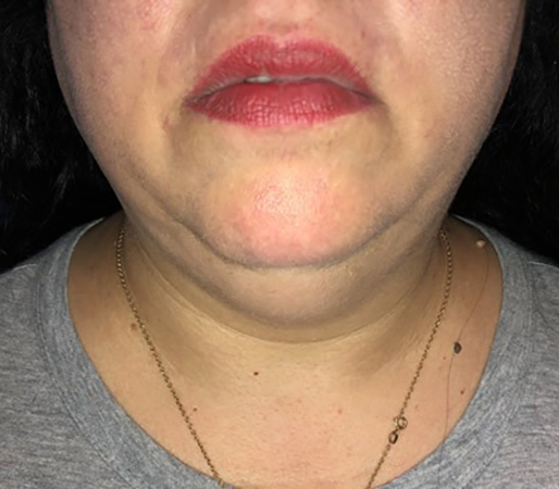 Case--21241 | Before Liposuction