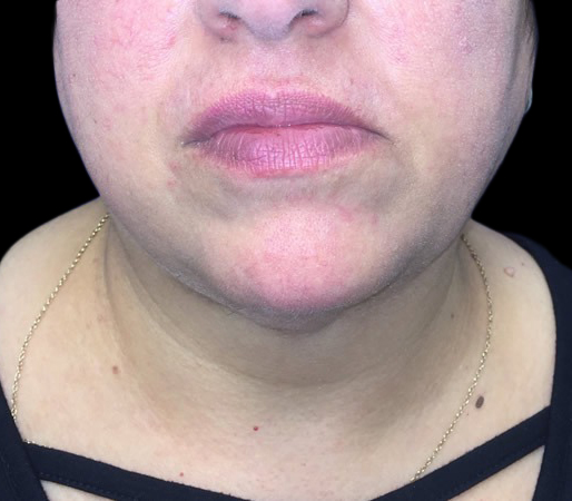 Case--21241 | After Liposuction